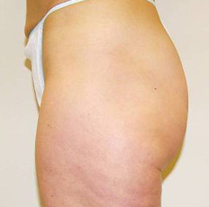 Cellulite après Technologie CELLU M6