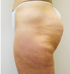 Cellulite avant Technologie CELLU M6